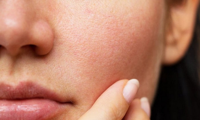 Nguyên nhân khiến da mặt bị khô vào ngày hè