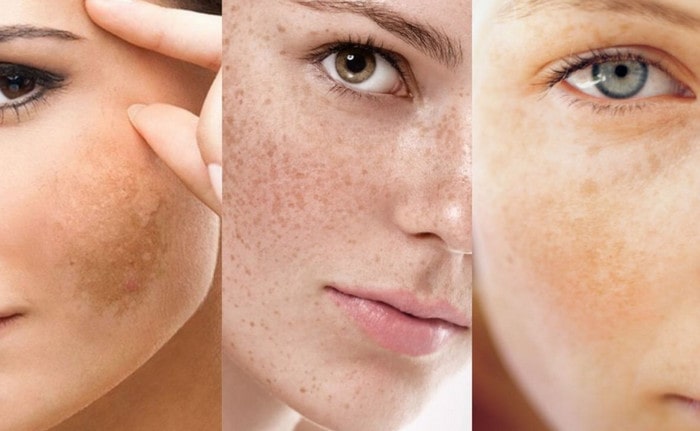 Bổ sung vitamin để ngăn ngừa, điều trị nám là rất cần thiết