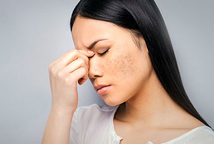Lão hóa là nguyên nhân khiến nám da xuất hiện