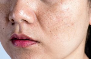Nám nội tiết như thế nào?