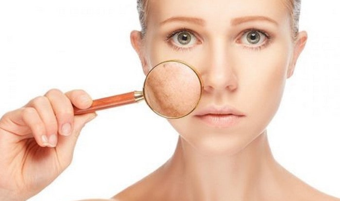 Dấu hiệu bị nám da nhẹ, nám nặng