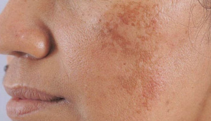 Nám mảng thường có màu sắc đậm, lan rộng ở trên bề mặt da