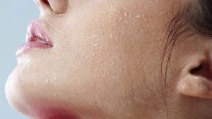 Nguyên nhân khiến da bị tróc vảy