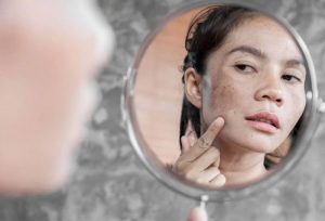 Nám da có chữa triệt để được không?