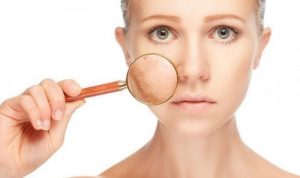 Dấu hiệu bị nám da nhẹ, nám nặng