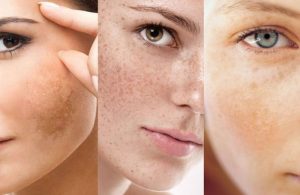 Nguyên nhân khiến mọi người bị nám mảng chân sâu, chân nông